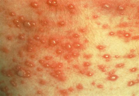bulutong hangin picture|Chickenpox .
